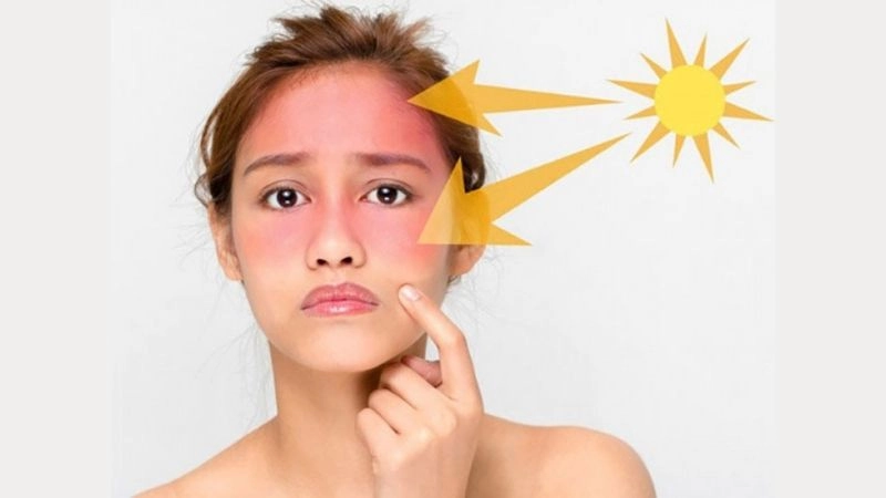 Cháy nắng dễ xảy ra khi da tiếp xúc lâu với nắng gắt