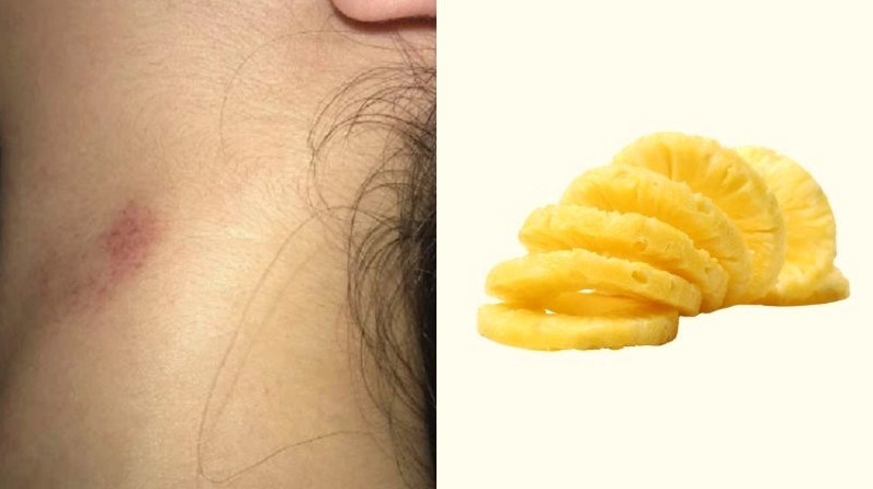 Bạn có thể đặt một lát dứa lên vết hickey để giảm đau
