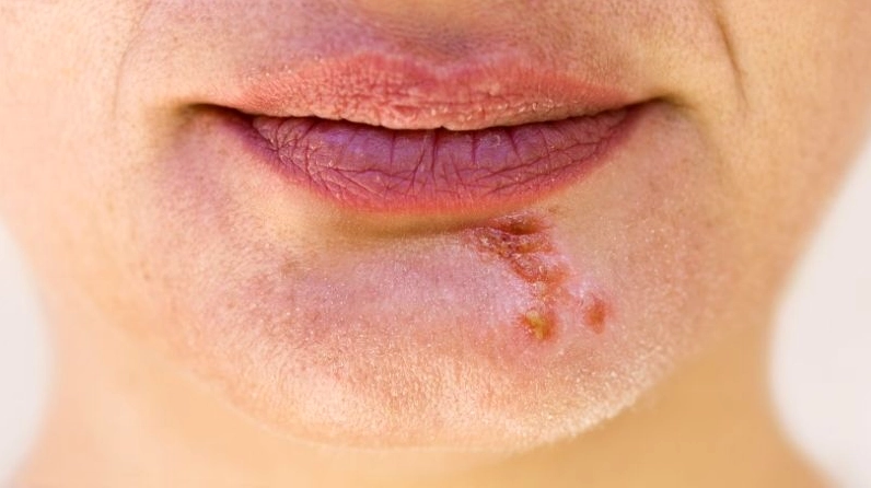 Bạn có thể nhiễm virus herpes qua vết hickey