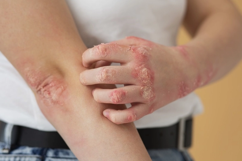 Hoạt chất từ cây lá ngón có thể hỗ trợ điều trị bệnh vảy nến