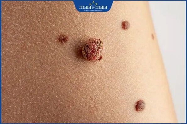 nốt ruồi dấu hiệu ác tính