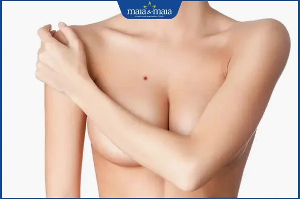 nốt ruồi son ngực nữ