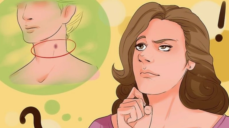 Vết hickey có thể tồn tại từ 3 ngày đến 2 tuần