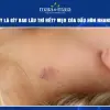 Hickey là cái gì Tìm hiểu chi tiết về dấu hôn và cách xử lý