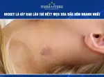Hickey là cái gì Tìm hiểu chi tiết về dấu hôn và cách xử lý