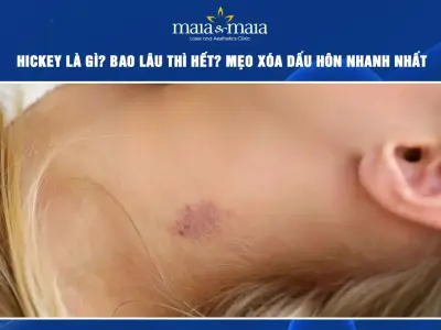 Hickey là cái gì Tìm hiểu chi tiết về dấu hôn và cách xử lý
